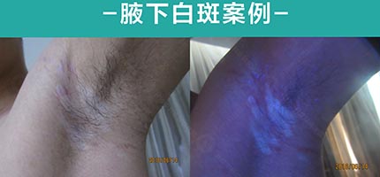 疑难性白癜风，在中科3月后白斑消退